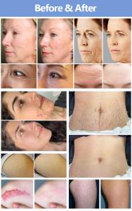 InMedor MF-168 RF Microneedling Machine-Professional Stationary Skin Firming Stretch Mark Removal for Skin (EU/US Plug)