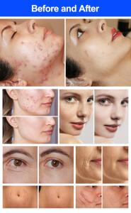 Portable Co2 Franctional Laser For Anti-Aging Skin Rejuvenation