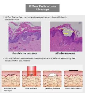 Desktop Thulium Laser 1927nm Skin Care Beauty Machine