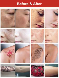 Desktop Picolaser Machine for Tattoo Removal Pigment Removal 532/755/1064nm