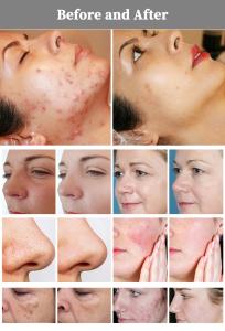 Desktop Thulium Laser Fiber 1927nm Laser Skin Resurfacing Equipment 1927nm Beauty Laser