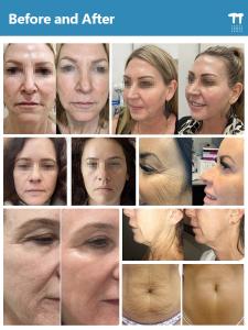 Fractional Machine Rf Professional Microneedling With Radio Frequency Machine for Facial Body Machine