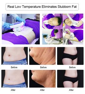 Fat Freezing Weight Loss Cellulite Removal Cool Therapy Big Handles 360 Cryo Slimming Machine
