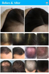 Scalp Treatment Machine Follicle Scalp Detection 650nm Laser Hair Growth/Regrowth Machine Anti-hair Loss Beauty Equipment
