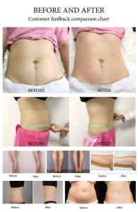 5 IN 1 MULTI-FUNCTION LIPO LASER WEIGHT LOSS DEVICE