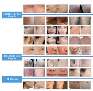 E-Light & RF & Picosecond LaserSkin Beauty Machine