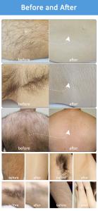 E-Light & RF & Picosecond LaserSkin Beauty Machine