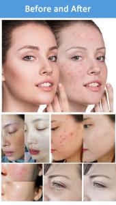 E-Light & RF & Picosecond LaserSkin Beauty Machine