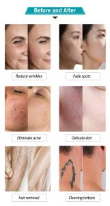 2 in1MultifunctionalIPL&Q-Switch Hair Removal and Skin Beauty