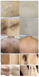 2 in1MultifunctionalIPL&Q-Switch Hair Removal and Skin Beauty
