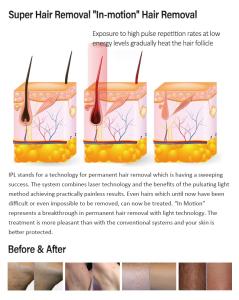 2 in1MultifunctionalIPL&Q-Switch Hair Removal and Skin Beauty