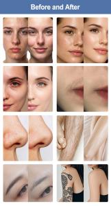 2 IN 1 Multifunctional 808nm Diode Laser For Hair Removal &Q-Switch For Skin Beauty