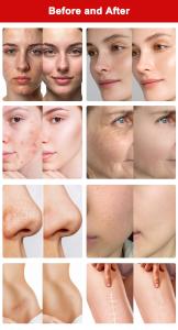 2 in 1 1927nm+1550nm Thulium Laser & Erbium Laser Skin Care Skin Rejuvenation  Beauty Machine ThulErbe Dual Pro 68